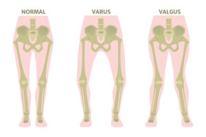 Read more about the article “The Hidden Truth About Valgus vs Varus: Are Your Legs at Risk?”
